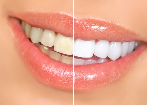 Bleaching